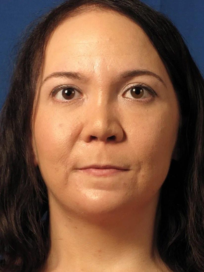 Marguerite J. Bernett, MD fat transfer after — Newport Beach, CA