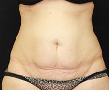Dr. York Yates Plastic Surgery fat freezing after — Layton, UT