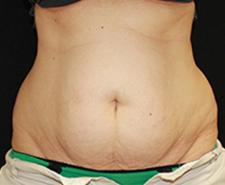 CoolSculpting before at Dr. York Yates Plastic Surgery in Layton, UT