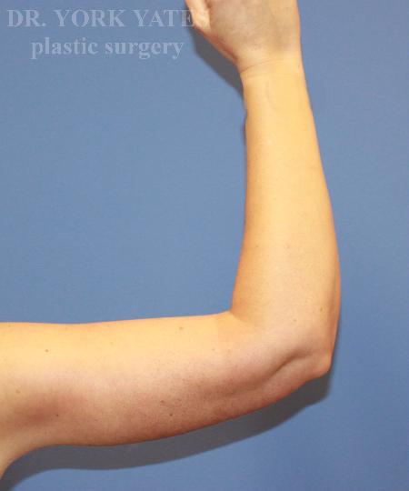Dr. York Yates Plastic Surgery arm lift after — Layton, UT