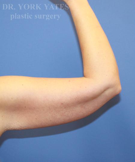 Arm Lift before at Dr. York Yates Plastic Surgery in Layton, UT