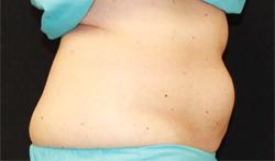 CoolSculpting after at Dr. York Yates Plastic Surgery in Layton, UT