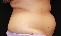 CoolSculpting before at Dr. York Yates Plastic Surgery in Layton, UT
