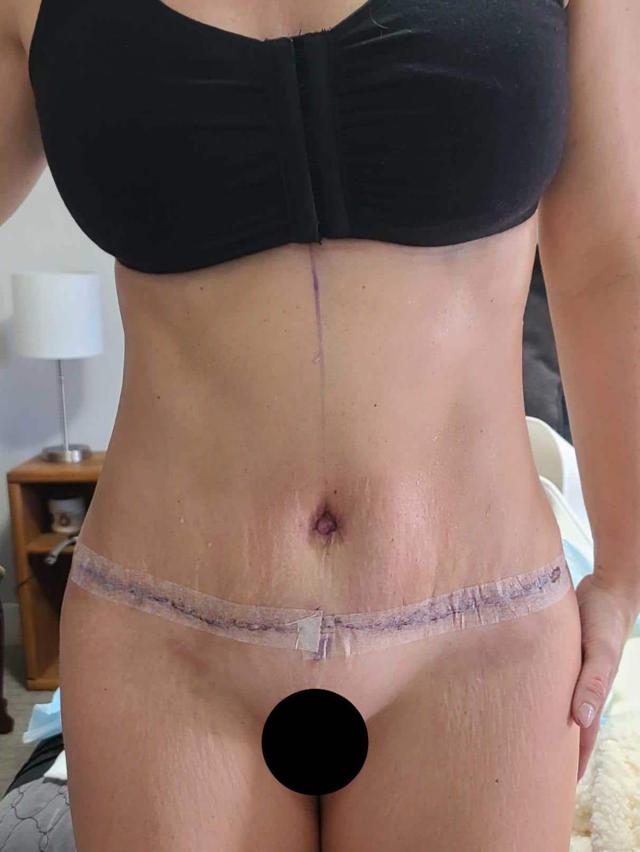 Mini Tummy Tuck after at Dr. York Yates Plastic Surgery in Layton, UT