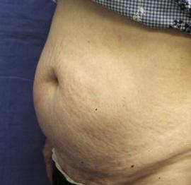 Mini Tummy Tuck before at Dr. York Yates Plastic Surgery in Layton, UT