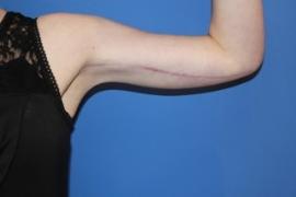 Arm Lift after at Dr. York Yates Plastic Surgery in Layton, UT