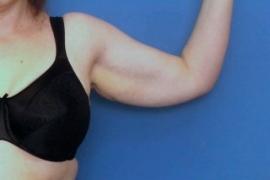 Arm Lift before at Dr. York Yates Plastic Surgery in Layton, UT