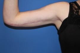 Arm Lift after at Dr. York Yates Plastic Surgery in Layton, UT