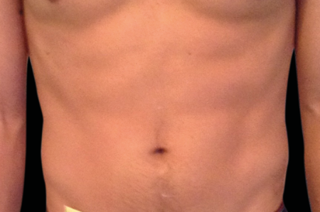 Dr. York Yates Plastic Surgery emsculpt after — Layton, UT