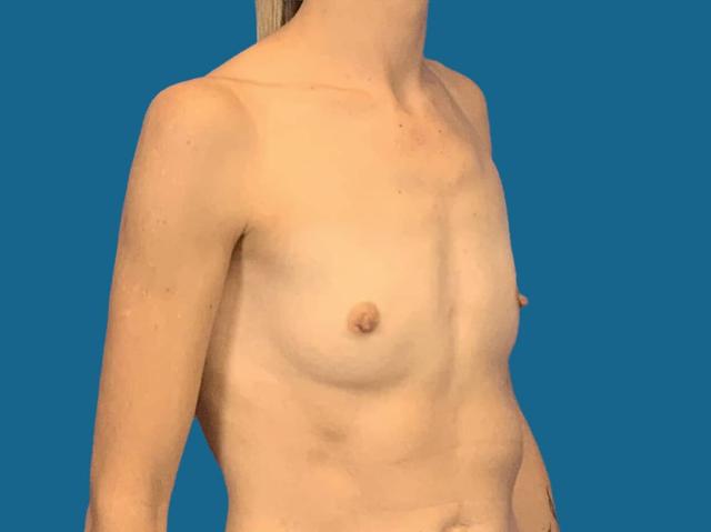 Breast Augmentation before at Dr. York Yates Plastic Surgery in Layton, UT