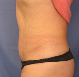 Mini Tummy Tuck after at Dr. York Yates Plastic Surgery in Layton, UT