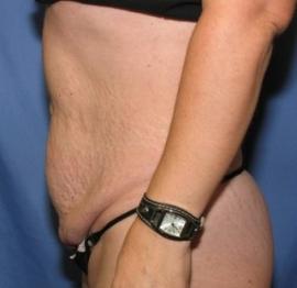Mini Tummy Tuck before at Dr. York Yates Plastic Surgery in Layton, UT