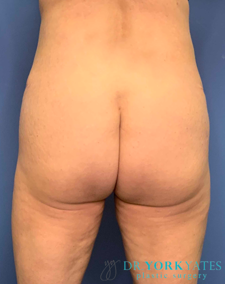 Liposuction after at Dr. York Yates Plastic Surgery in Layton, UT