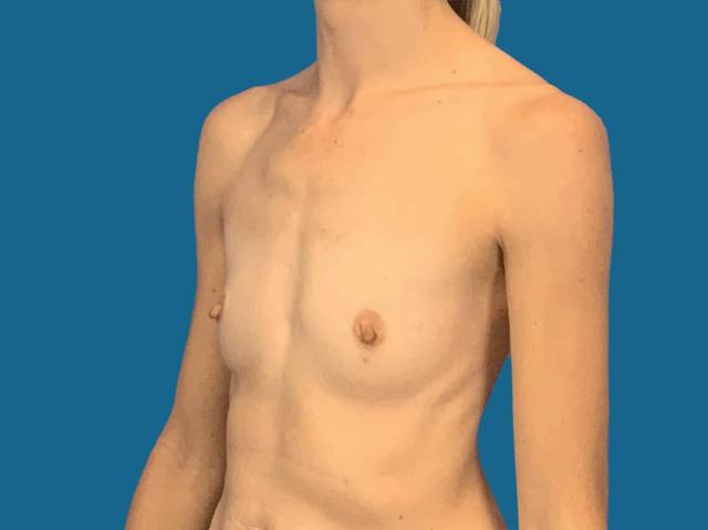Breast Augmentation before at Dr. York Yates Plastic Surgery in Layton, UT