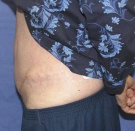 Tummy Tuck after at Dr. York Yates Plastic Surgery in Layton, UT