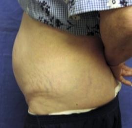 Tummy Tuck before at Dr. York Yates Plastic Surgery in Layton, UT