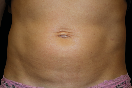 Dr. York Yates Plastic Surgery emsculpt after — Layton, UT