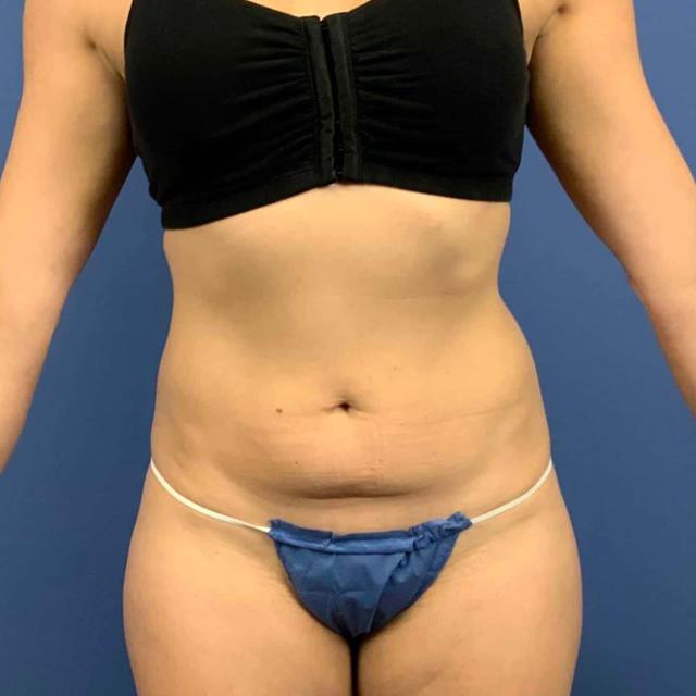 Liposuction before at Dr. York Yates Plastic Surgery in Layton, UT