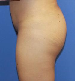 Brazilian Butt Lift after at Dr. York Yates Plastic Surgery in Layton, UT