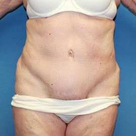 Dr. York Yates Plastic Surgery body contouring after — Layton, UT
