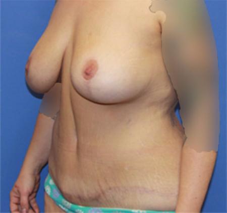 Dr. York Yates Plastic Surgery body contouring after — Layton, UT