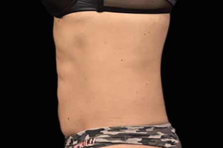 Dr. York Yates Plastic Surgery emsculpt after — Layton, UT