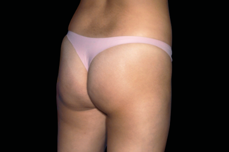 Dr. York Yates Plastic Surgery emsculpt after — Layton, UT