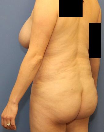 Brazilian Butt Lift after at Dr. York Yates Plastic Surgery in Layton, UT