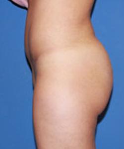 Brazilian Butt Lift after at Dr. York Yates Plastic Surgery in Layton, UT