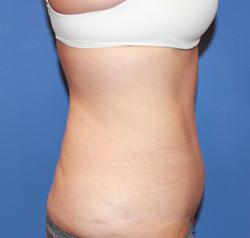 Dr. York Yates Plastic Surgery body contouring after — Layton, UT