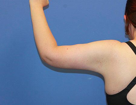 Dr. York Yates Plastic Surgery arm lift after — Layton, UT