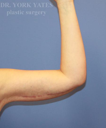 Dr. York Yates Plastic Surgery arm lift after — Layton, UT