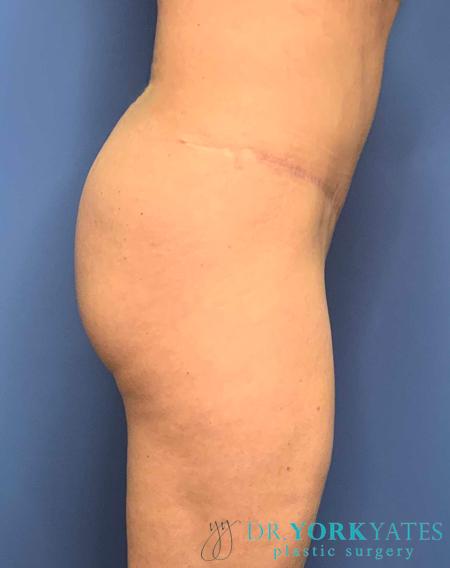 Liposuction after at Dr. York Yates Plastic Surgery in Layton, UT