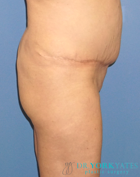 Liposuction before at Dr. York Yates Plastic Surgery in Layton, UT