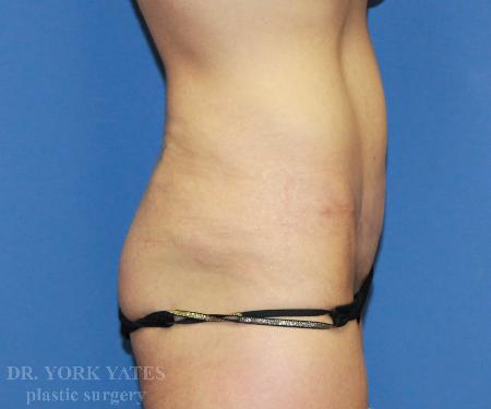 Mini Tummy Tuck after at Dr. York Yates Plastic Surgery in Layton, UT