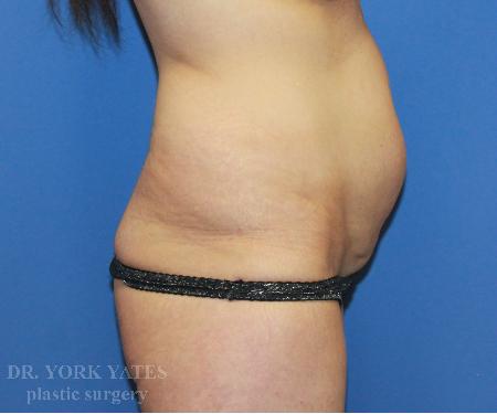 Mini Tummy Tuck before at Dr. York Yates Plastic Surgery in Layton, UT