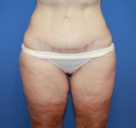 Dr. York Yates Plastic Surgery body contouring after — Layton, UT