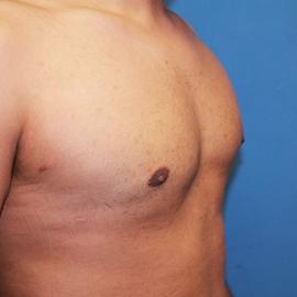 Dr. York Yates Plastic Surgery gynecomastia after — Layton, UT