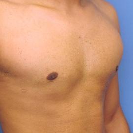 Gynecomastia Surgery before at Dr. York Yates Plastic Surgery in Layton, UT