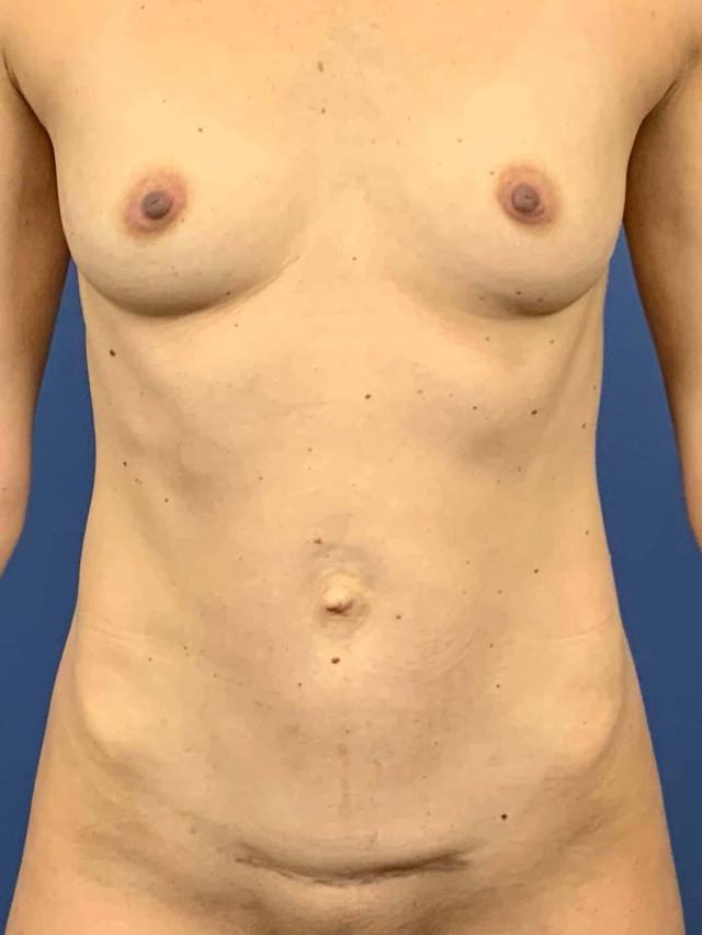 Mommy Makeover before at Dr. York Yates Plastic Surgery in Layton, UT
