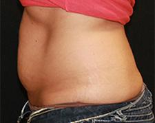 CoolSculpting after at Dr. York Yates Plastic Surgery in Layton, UT