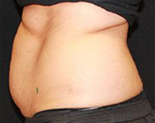 CoolSculpting before at Dr. York Yates Plastic Surgery in Layton, UT