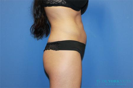 CoolSculpting before at Dr. York Yates Plastic Surgery in Layton, UT