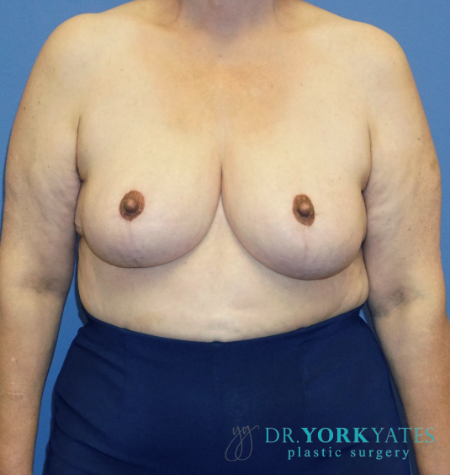 Breast Reduction after at Dr. York Yates Plastic Surgery in Layton, UT