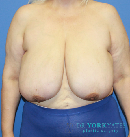 Breast Reduction before at Dr. York Yates Plastic Surgery in Layton, UT