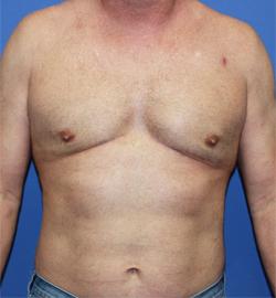 Dr. York Yates Plastic Surgery gynecomastia after — Layton, UT