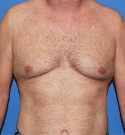 Gynecomastia Surgery before at Dr. York Yates Plastic Surgery in Layton, UT