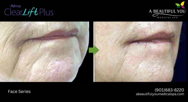 A Beautiful You Medical Spa result — Memphis, TN