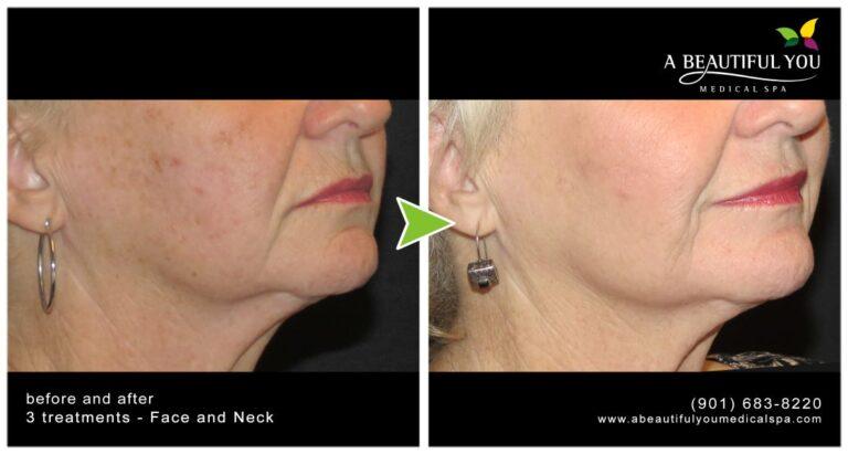A Beautiful You Medical Spa result — Memphis, TN