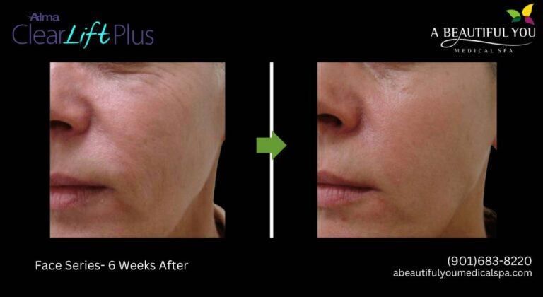 A Beautiful You Medical Spa result — Memphis, TN